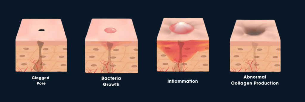 Acne Scar Progress